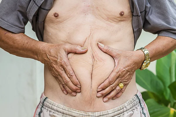 old man squeezing belly fat around belly button