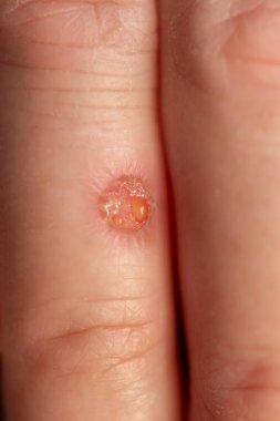 Close up of a round shaped fresh wound on a finger; detail of fresh hand injury with exudate leaking from the wound while its healing and forming scab clipart