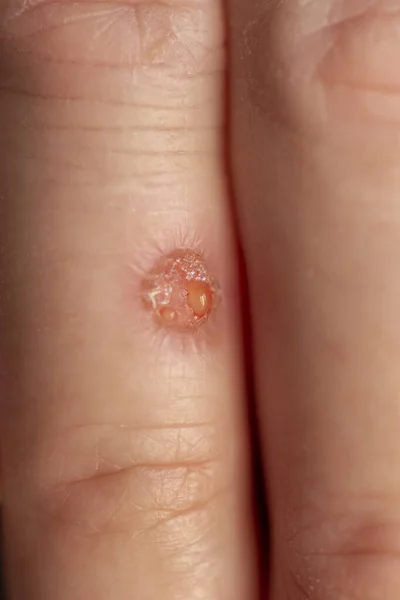 Close up of a round shaped fresh wound on a finger; detail of fresh hand injury with exudate leaking from the wound while its healing and forming scab