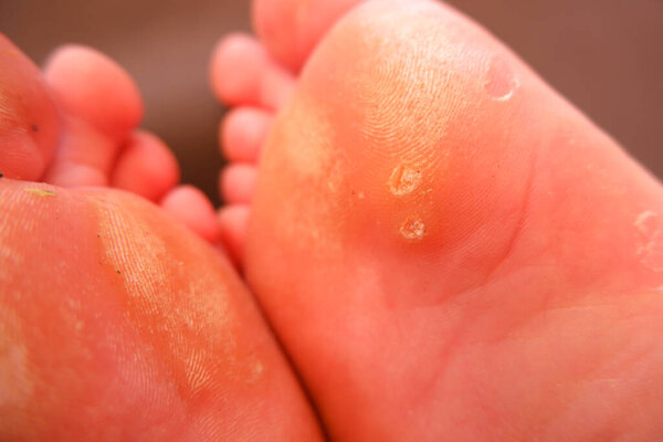 a fungal infection on the sole of a foot up close