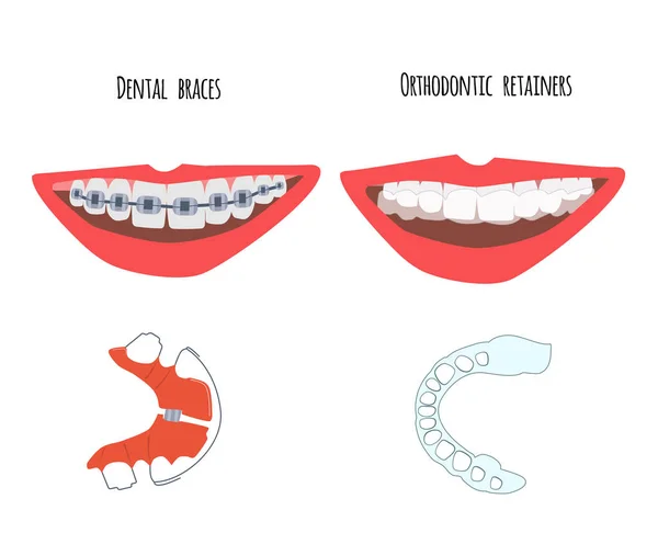 Twee Menselijke Mond Met Gebitsbeugels Orthodontische Transparante Beugels Tanden Keuze — Stockvector