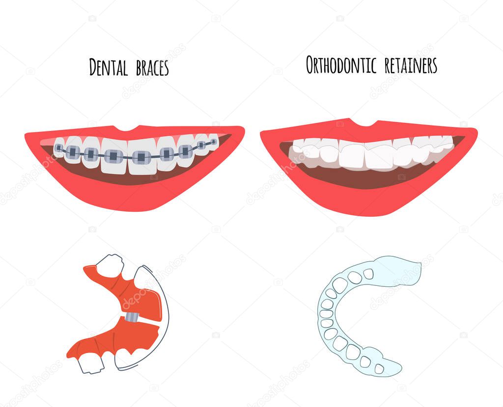Two human mouth with dental braces and orthodontic transparent retainers on teeth. Choice between them. Oral care,bite correction. Beautiful straight  smile. Vector flat illustration for clinic