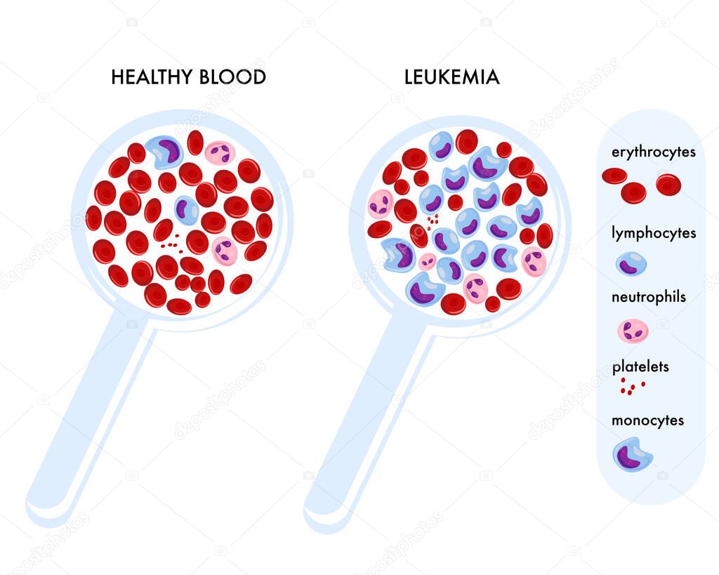 Magnifying glass with normal blood and with leukemia.Medical science education and healthcare awareness.Cells Erythrocytes, leukocytes,neutrophils.Blood cancer or Hemophilia concept.Diagnosis Diagram