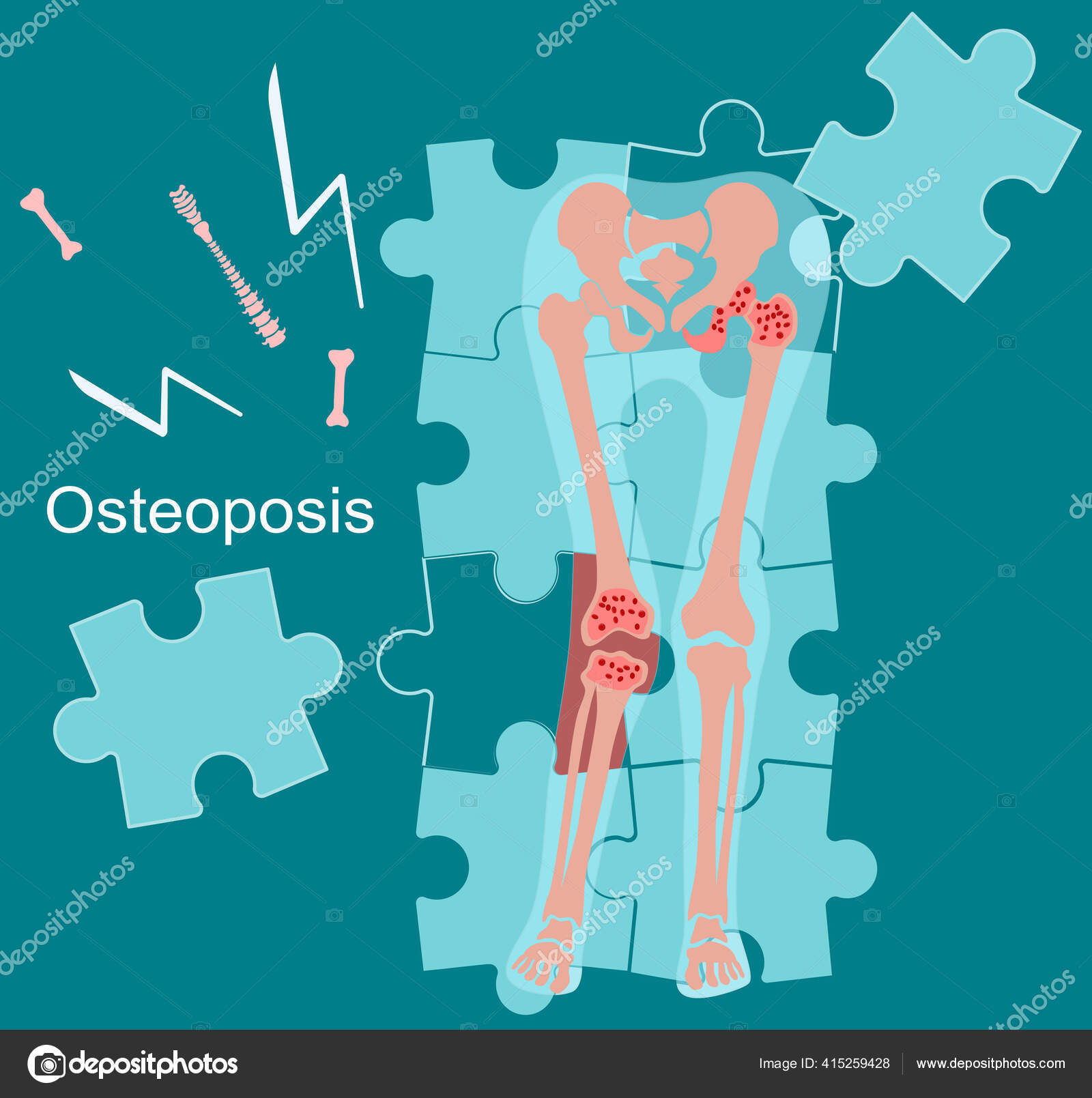 térd osteoporosis artrosis
