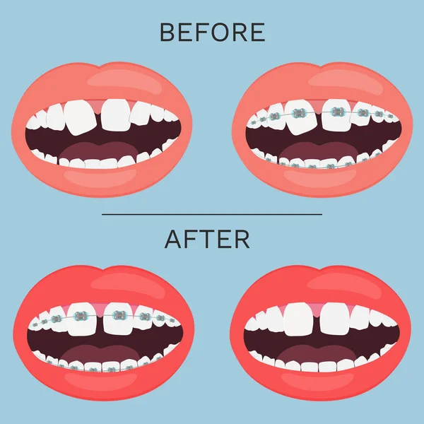 Denti con correzione tutore prima e dopo illustrazione vettoriale di serie.. — Vettoriale Stock