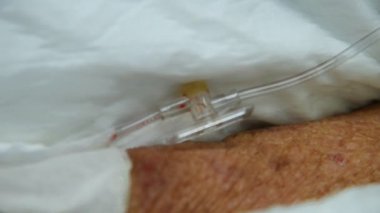 Hasta yaşlı hasta yandan intravenöz serum fizyolojik ile hastaneye