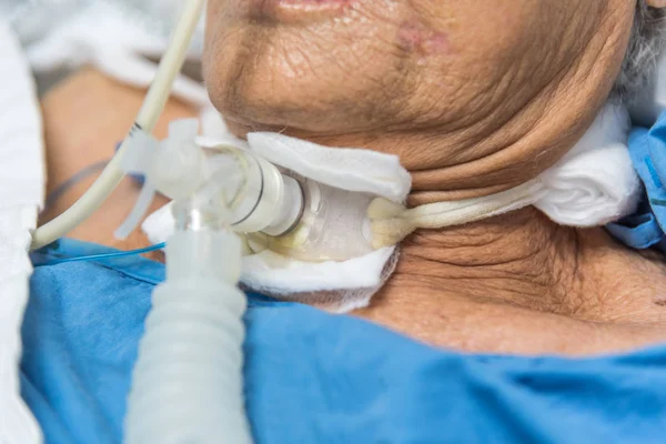 Les Patientes Âgées Asiatiques Des Années Font Trachéostomie Utilisent Ventilateur — Photo