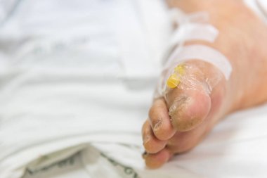 Hasta Asya yaşlı kadınlarla 80s serum C-line veya A-line, intravenöz bir yaşlı hasta üzerinde taban Hastanesi yoğun bakım ünitesi (yoğun bakımda.) odadaki hasta yatağı üzerinde ayak.