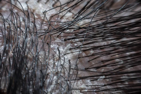 Macro of hair scalp asian human with black hairline have a problem with dandruff and scaly from psoriasis because hormonal, dirty and stress