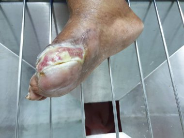 Hasta iyileşmesi yaralar diabetes mellitus