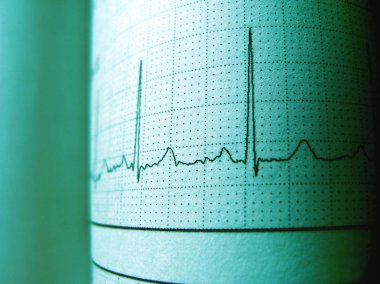 Sinüs kalp ritmi üzerinde elektrokardiyogram kayıt kağıt gösterilen Normal P dalgası, halkla ilişkiler ve Qt aralığı ve Qrs kompleksi, Ekg kağıt                            