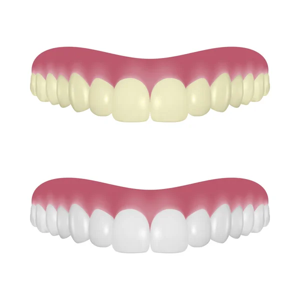 Vector 3D Realistic Render Denture Set Closeup Isolado em fundo branco. Odontologia e Ortodontia Design. Dentes Humanos para Conceito Médico e Pasta Dentária. Higiene Oral Saudável, Prótese da mandíbula —  Vetores de Stock