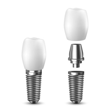 Vektör 3d Gerçekçi Render Beyaz Diş İmplant ı Simge Set Closeup Beyaz Arka Plan üzerinde izole. Diş, Tıp ve Sağlık Kavramı. Protez Yapısı Tasarım Şablonu. Ön Görünüm