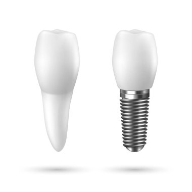 Vektör 3d Gerçekçi Render Beyaz Diş İmplant ı Simge Set Closeup Beyaz Arka Plan üzerinde izole. Diş, Tıp ve Sağlık Kavramı. Protez Yapısı Tasarım Şablonu. Ön Görünüm