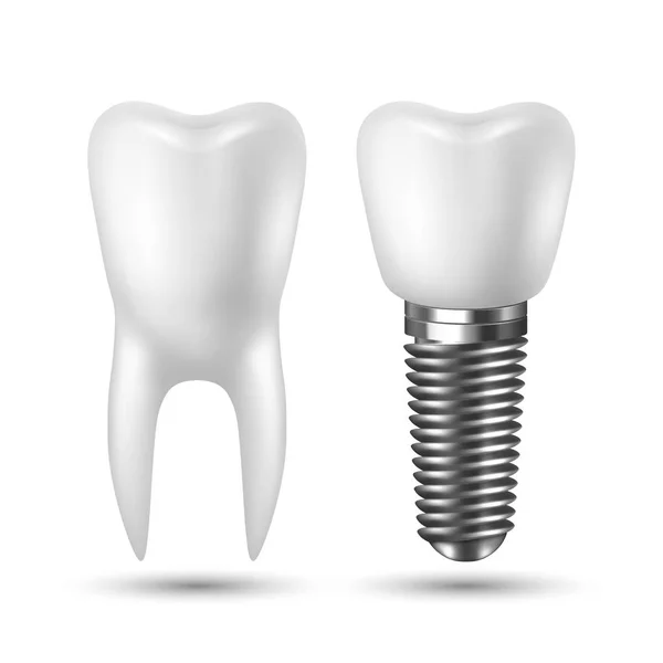 Vektoros 3D reális Render fehér fogak implantátum fogsor Icon szett closeup izolált fehér háttér. Fogászati, orvosi és egészségügyi koncepció. A protézis szerkezetének tervezősablonja. Elülső nézet — Stock Vector