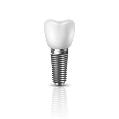 Vektör 3d Gerçekçi Render Beyaz Diş İmplant ı Simge Set Closeup Beyaz Arka Plan üzerinde izole. Diş, Tıp ve Sağlık Kavramı. Protez Yapısı Tasarım Şablonu. Ön Görünüm