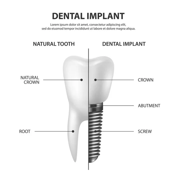 Vector 3D Realistic Render White Tooth Implant Denture Primer plano aislado sobre fondo blanco. Dental, Medicine and Health Concept. Plantilla de diseño de la estructura de prótesis. Vista frontal — Vector de stock