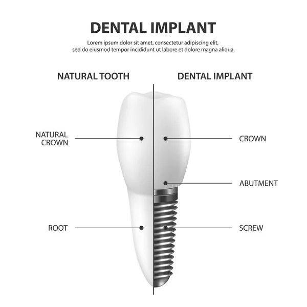 Vector 3D Realistic Render White Tooth Implant Denture Primer plano aislado sobre fondo blanco. Dental, Medicine and Health Concept. Plantilla de diseño de la estructura de prótesis. Vista frontal — Vector de stock