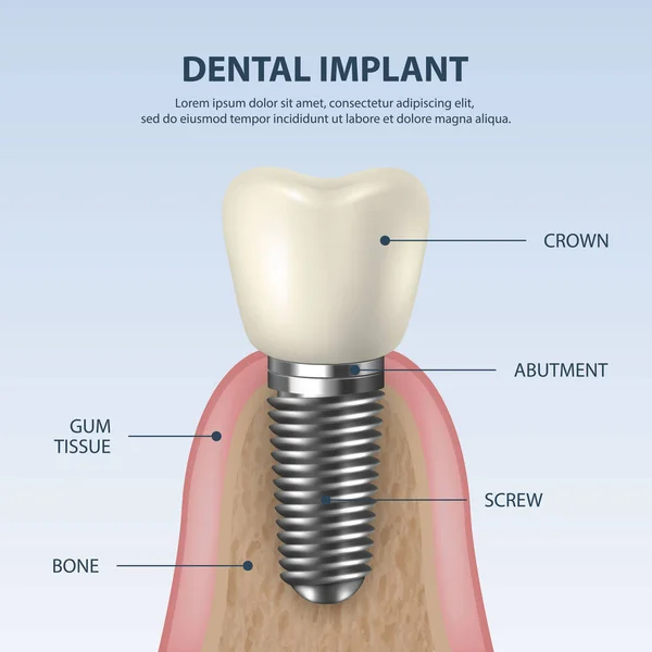 Fondo vectorial con 3D Realistic Render White Tooth Implant Denture Primer plano. Dental, Medicine and Health Concept. Plantilla de diseño de la estructura de prótesis. Vista frontal — Vector de stock