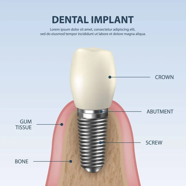 Fondo vectorial con 3D Realistic Render White Tooth Implant Denture Primer plano. Dental, Medicine and Health Concept. Plantilla de diseño de la estructura de prótesis. Vista frontal — Vector de stock