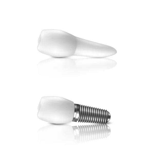 Vektor 3D realistiska göra vit tand och implantat protes i horisontell närbild isolerad på vit bakgrund. Tand-, medicin-och hälsokoncept. Formgivningsmall för protes struktur. Vy framifrån — Stock vektor