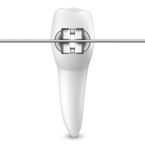 Vector 3d Realistisk tand med hängslen Ikonen Närbild Isolerad på vit bakgrund. Medicinsk tandläkardesign mall, Clipart. Begreppet tandhälsa — Stock vektor