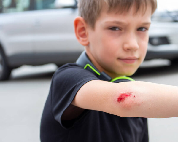 Selective focus Boy with a fresh wound on his arm, elbow with blood. The man injured his hand after falling. Copy space