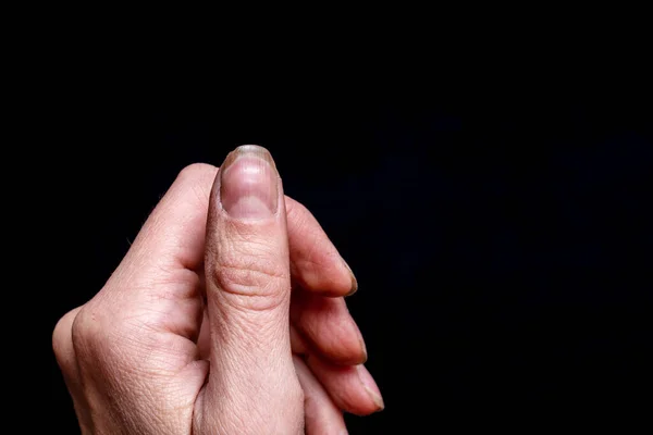 Close-up of a female thumb with a soft fossa on a nail, an overgrown cuticle, a peeling nail layer, poor manicure on a black background. Unhealthy Nail Concept