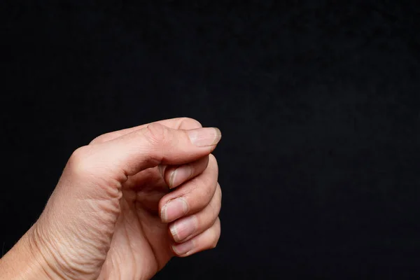 Close Uma Mão Humana Com Unhas Cutículas Cobertas Camada Escamosa — Fotografia de Stock