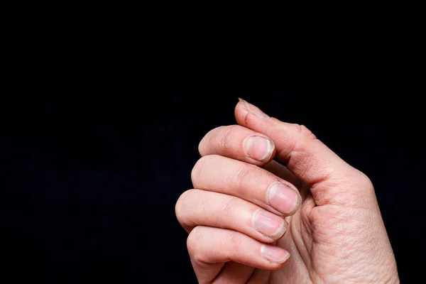 女性高加索手的特写与肮脏易碎的钉子 破碎的钉子在黑色的背景 在钉子上剥皮 指甲和手部护理概念 — 图库照片