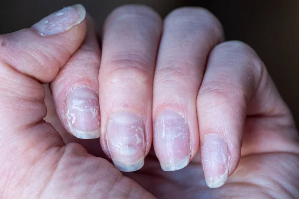 Gros Plan Des Ongles Cassants Dommages Ongle Après Avoir Utilisé — Photo