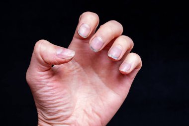 Kirli, kırılgan tırnakları ve siyah arka planda kırık tırnakları olan beyaz kadın eli. Çivi söküyorum. Çivi ve el bakımı konsepti