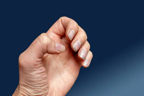 Крупный План Женской Кавказской Руки Грязными Ломкими Ногтями Сломанными Ногтями — стоковое фото