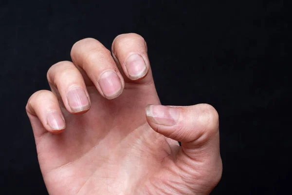 Κοντινό Πλάνο Του Γυναικείου Καυκάσιου Χεριού Βρώμικα Εύθραυστα Νύχια Σπασμένα — Φωτογραφία Αρχείου