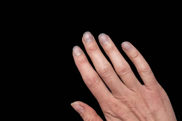 Detailní záběr ženské bělošské ruky se špinavými křehkými nehty, zlomenými nehty na černém pozadí. Loupání na hřebících — Stock fotografie