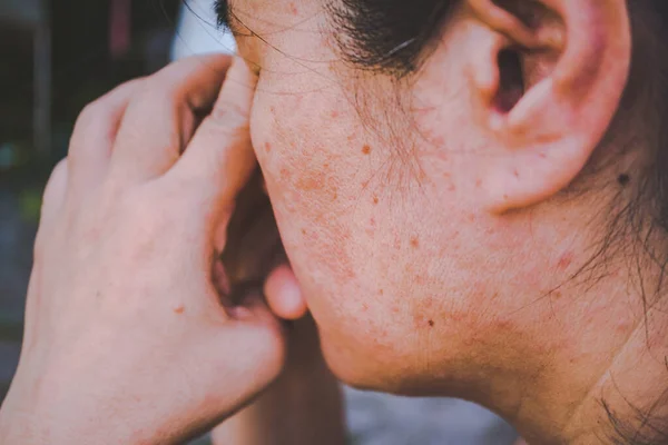 Vrouwen Die Problemen Stress Problemen Hebben Vrouwen Met Huidproblemen Acne — Stockfoto