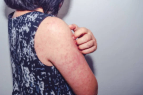 Kızamık virüsünün bulanık dermatiti sırtı kaşındığı için dermatiti olan bir kadın urtikia, sağlık sorunları Coronavirus 'a bağlı Kawasaki hastalığı..