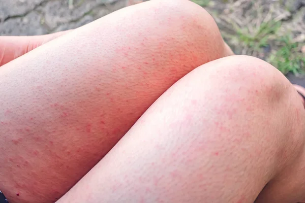 Hudsjukdom Kroppen Viral Hudsjukdom Mässling Utslag Med Dermatit Kliande Blåsor — Stockfoto