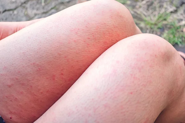 Huidziekte Het Lichaam Virale Huidziekte Mazelen Huiduitslag Met Dermatitis Van — Stockfoto