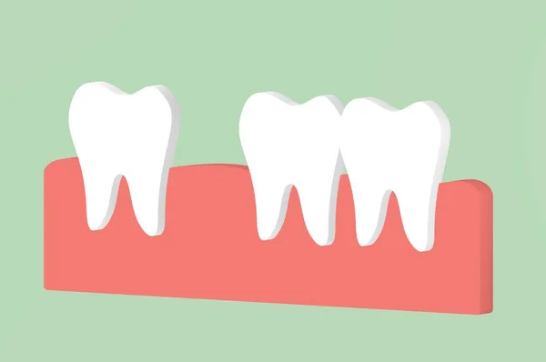 Espaciando Los Dientes Diastema Caricatura Dental Renderizar Estilo Plano Lindo —  Fotos de Stock