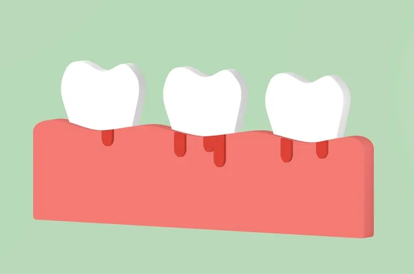 periodontitis veya periodontal hastalık kanama, diş - diş etrafında dişeti doku iltihabı ile çizgi film 3d render düz stil şirin karakter tasarımı için
