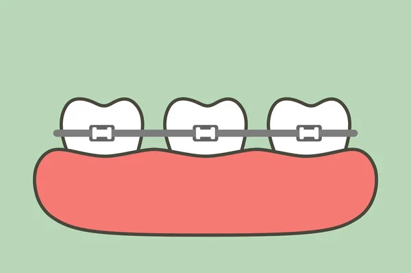 Denti Ortodontici Bretelle Dentali Dente Vettore Del Fumetto Stile Piatto — Vettoriale Stock