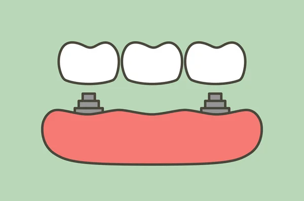 Tooth Implant Bridge Installation Process Change New Root Teeth Dental — Stock Vector