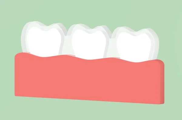 Zęby Nosić Trener Silikonu Lub Aparaty Lingwalne Dental Render Płaski — Zdjęcie stockowe