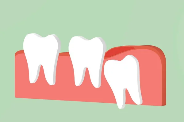 yirmilik diş (açısal veya mesial sıkışması) ile inflamasyon etkiler diğer diş - diş çizgi film 3d render düz stil şirin karakter tasarımı için