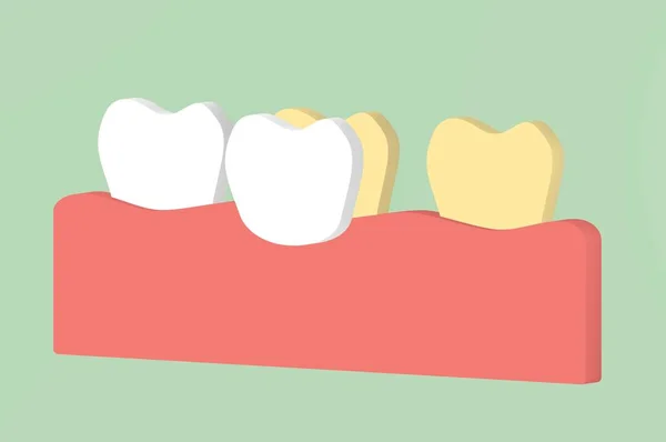 Wybielanie Zębów Przez Licówki Zęby Dental Render Płaski Cute Postać — Zdjęcie stockowe