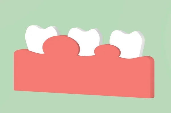dişeti iltihabı veya periodontal hastalık, diş - etrafında dişeti doku iltihabı diş çizgi film 3d render düz stil şirin karakter tasarımı için