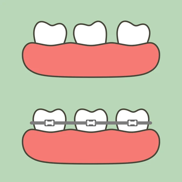 正畸治疗的步骤 牙科卡通矢量扁平式设计的可爱性格 — 图库矢量图片