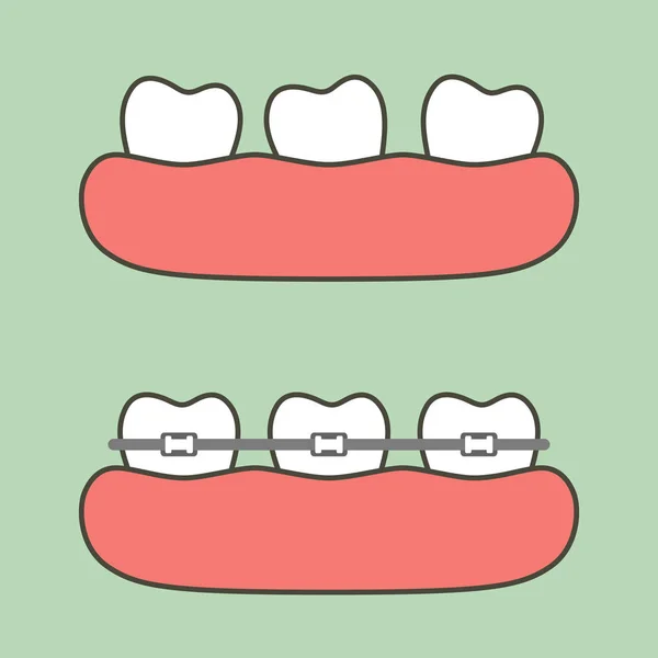 Passo Tratamento Ortodôntico Antes Depois Desenho Animado Dental Estilo Plano —  Vetores de Stock