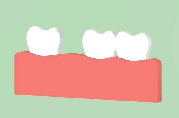 Rozstaw Zębów Diastemy Dental Kreskówka Render Płaskie Stylu Cute Znaków — Zdjęcie stockowe